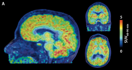 Martinostat imaging of the human brain