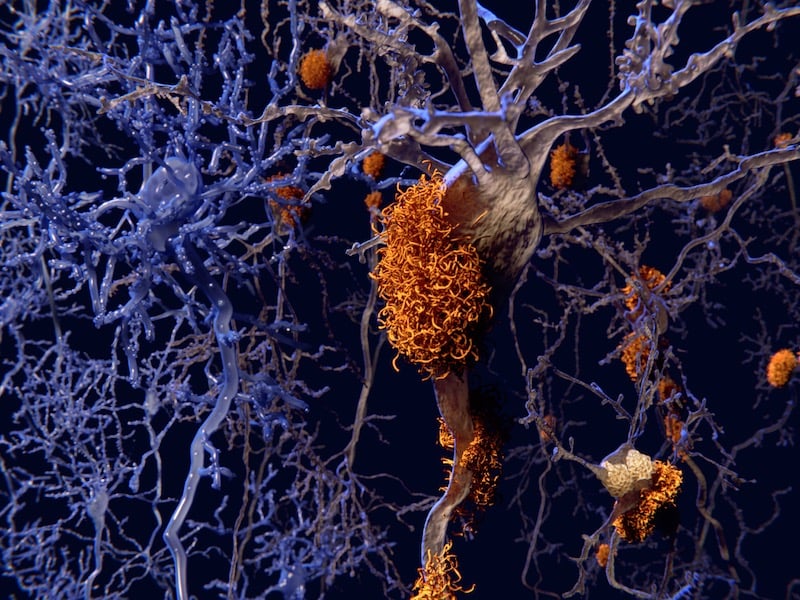 Illustration of Amyloid plaques around neurons alongside healthy neurons