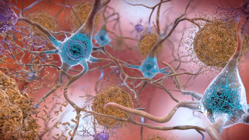 Artist rendering of amyloid and tau deposits associated with Alzheimers disease