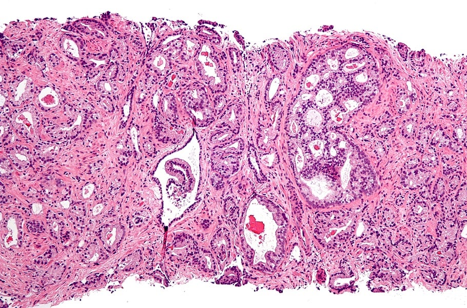 Micrograph showing the most common prostate cancer