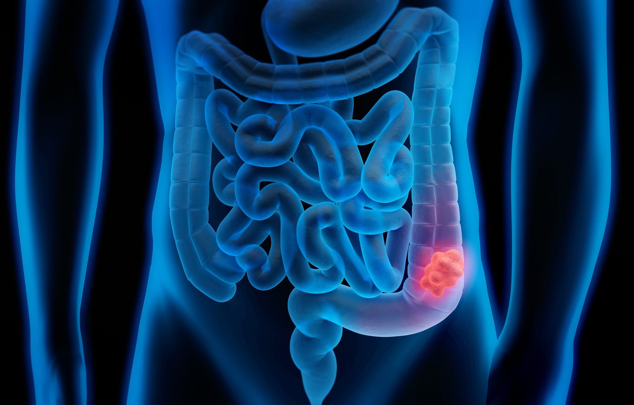 A 3D illustration of colon cancer