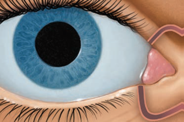 Eye Ocular Therapeutix procedure