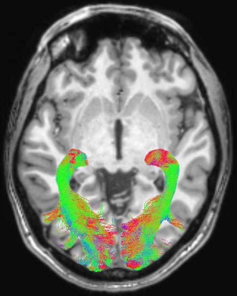 Brain image from Parkinsons study