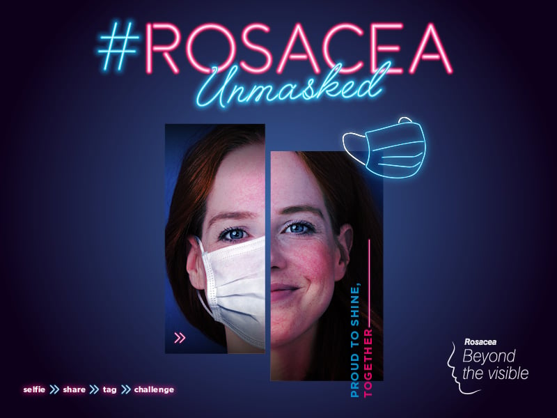 Woman with rosacea mask on and off
