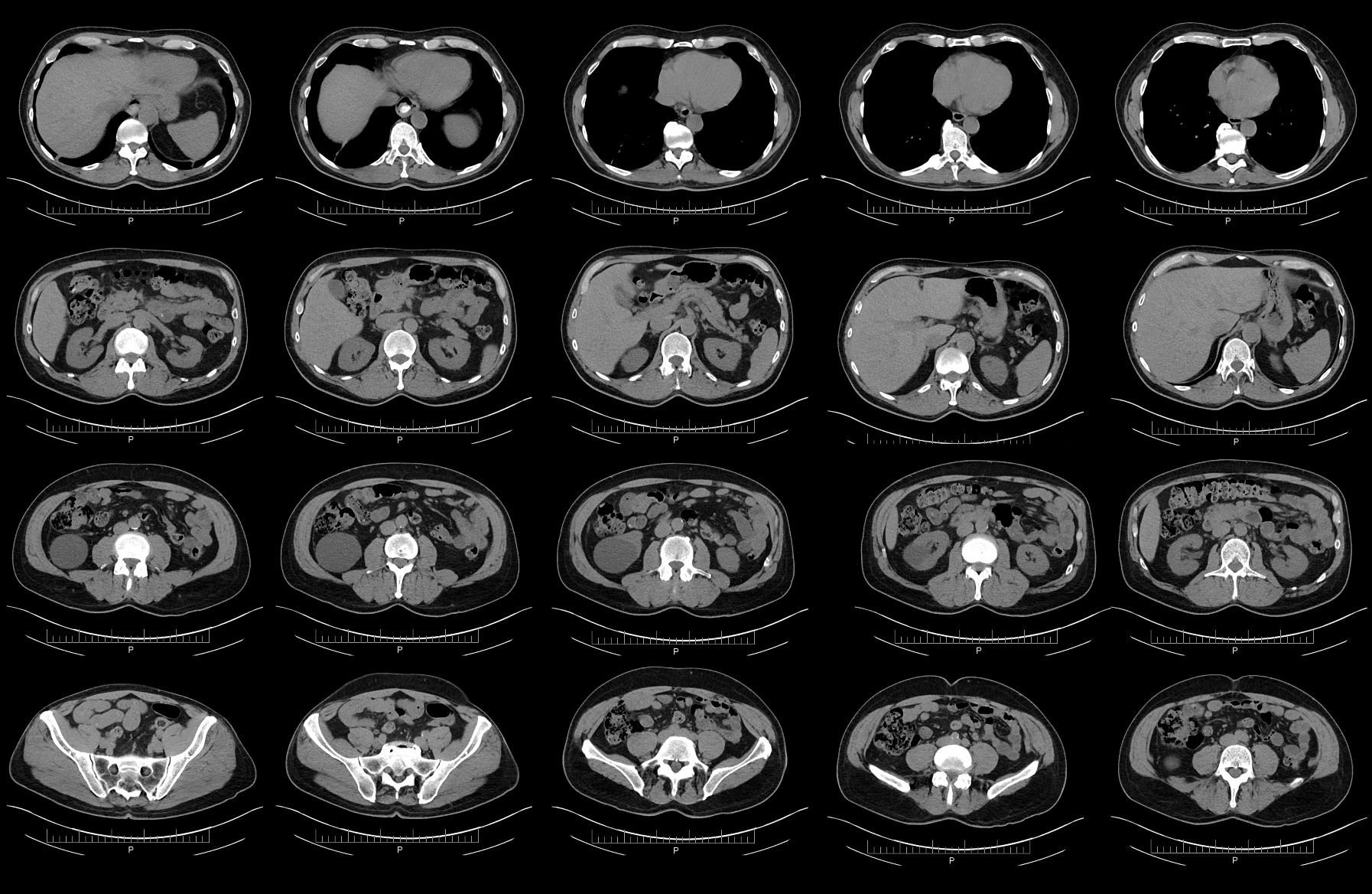 Abdominal CT pancreas