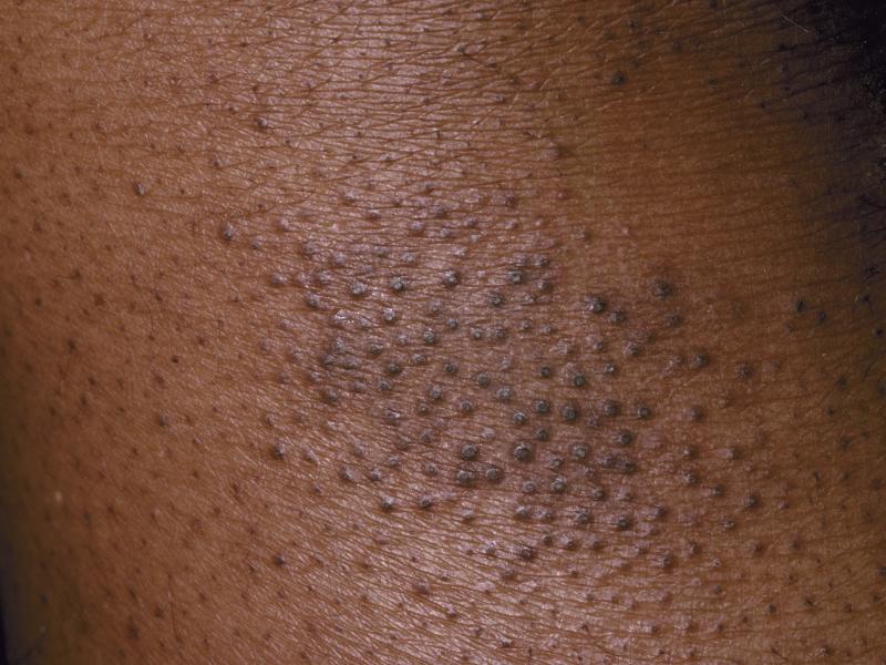 Eczema, skin of color. VisualDx