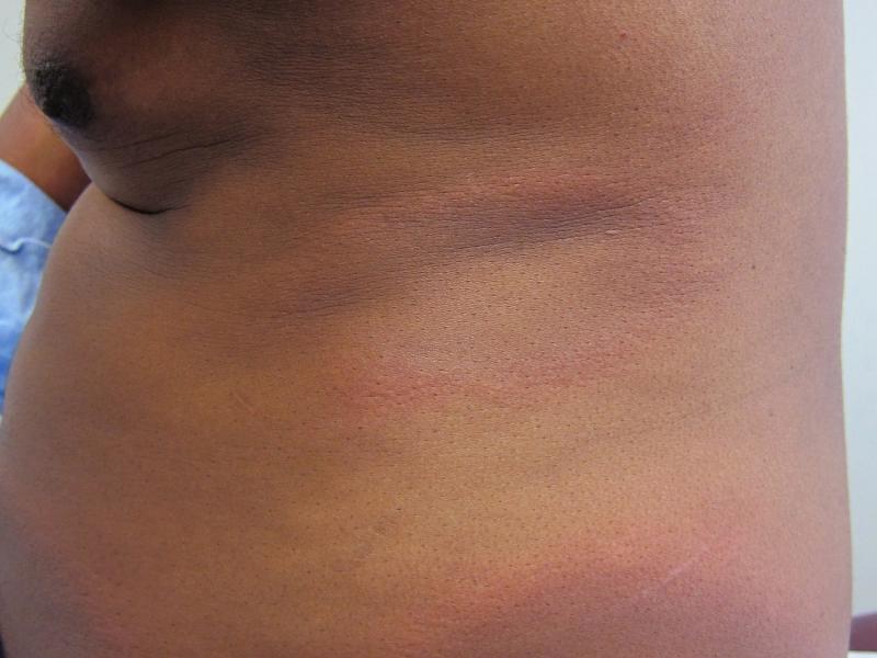 Lyme disease, skin of color. Credit: VisualDx