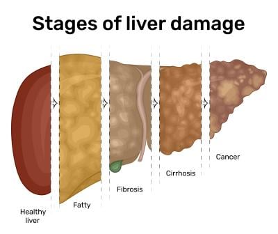 liver disease, fibrosis, NASH, NAFLD, cancer, cirrhosis