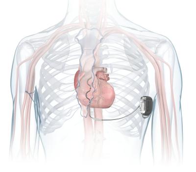 Medtronic claims FDA approval for defibrillator implant routed outside ...