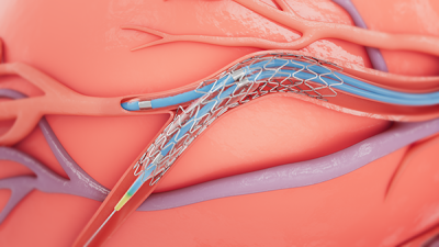 Medtronic bifurcation stent