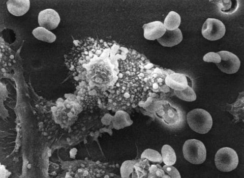 macrophages killing cancer under electron microscope
