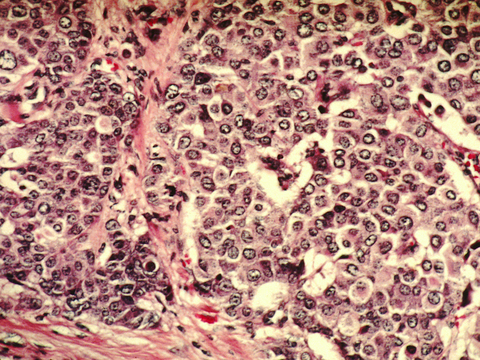 Breast cancer cells