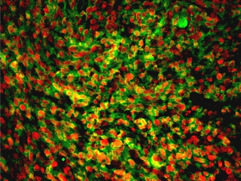 Cerebellar stem cells that give rise to aggressive brain cancers, such as medulloblastoma