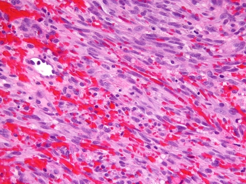 Kaposi's sarcoma