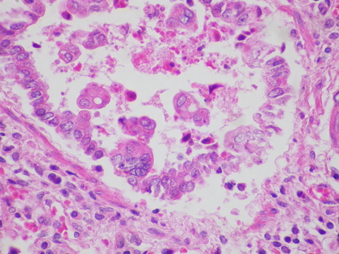 respiratory syncytial virus