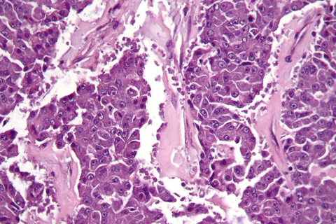 Pancreatic Cancer