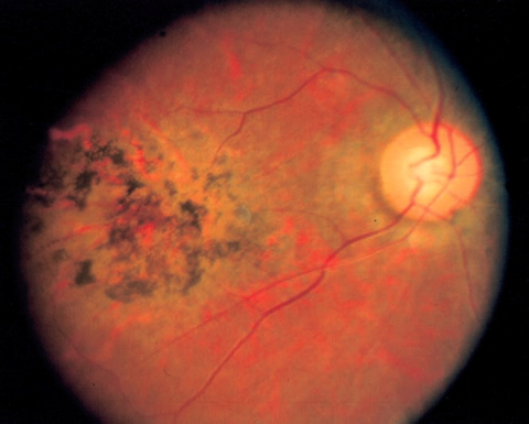 Eye