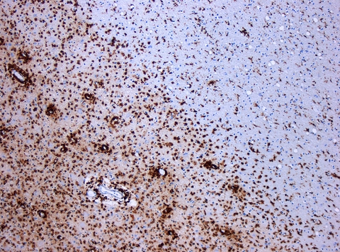 MS Demyelinisation