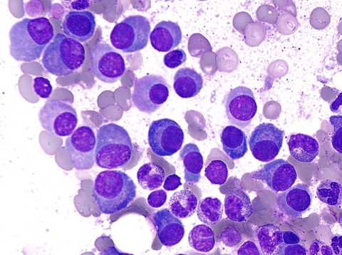 myeloma cells