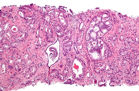 Prostate cancer