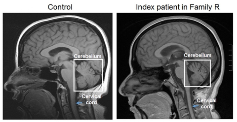 Ataxia