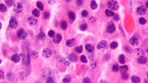 Multiple myeloma