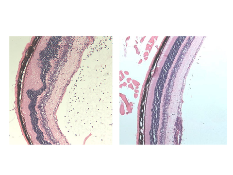uveitis