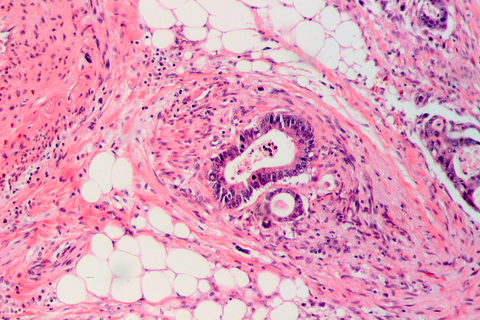 Colorectal cancer