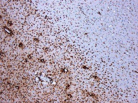 Demyelination by MS. The CD68 colored tissue shows several macrophages in the area of the lesion. Original scale 1:100