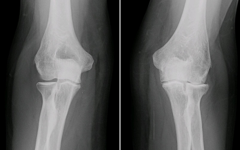 Osteoarthritis