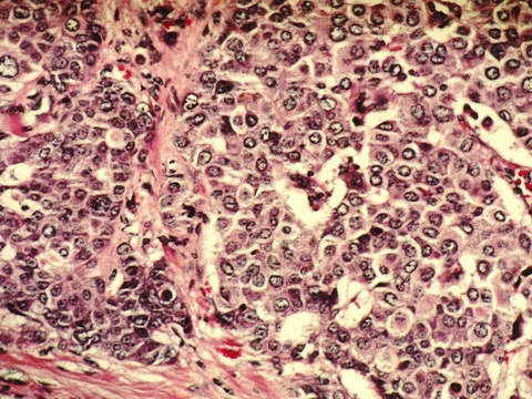 breast cancer breast cancer