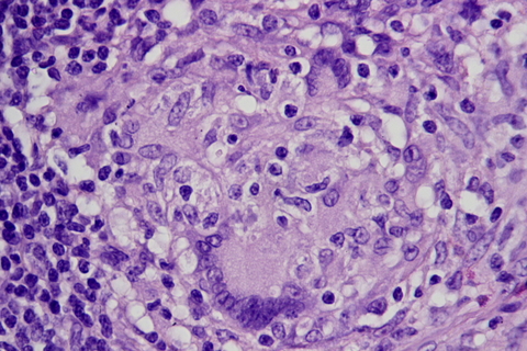 crohn's crohn's