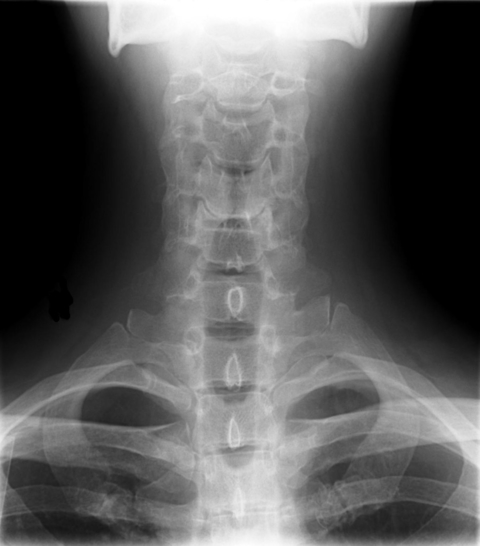 X-ray of cervical spine X-ray of cervical spine