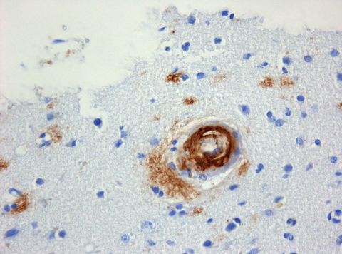 Amyloid Amyloid