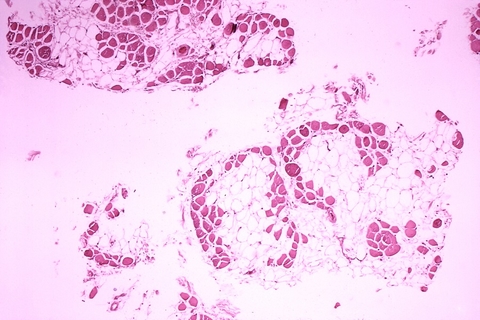Duchenne muscular dystrophy Duchenne muscular dystrophy