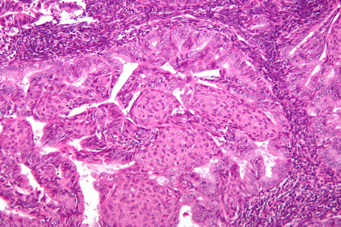 EndometrialCancer Endometrial Cancer