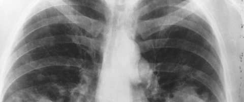 Lung X-ray Lung X-ray