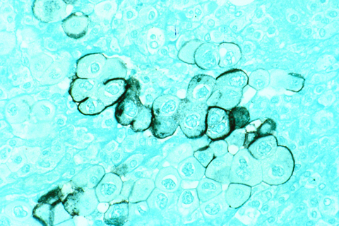 Pancreatic cancer Human tumor cells from the pancreas