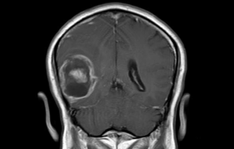 glioblastoma glioblastoma