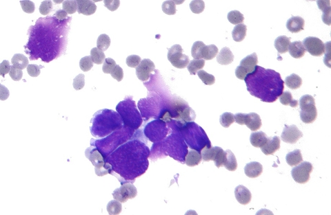 Small cell lung cancer (Michael Bonert CC BY-SA 3.0) Micrograph of small cell lung cancer