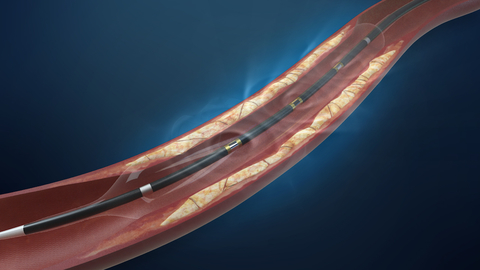 ShockWave lithoplasty balloon ShockWave lithoplasty balloon