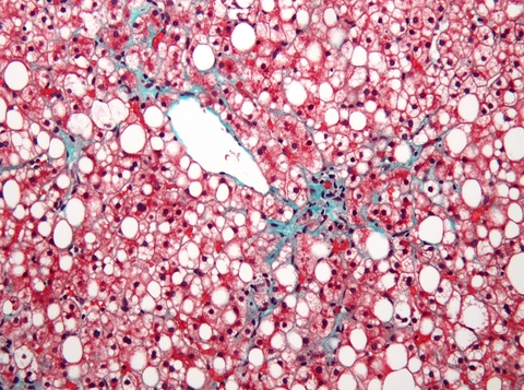 NASH microscope image of nash