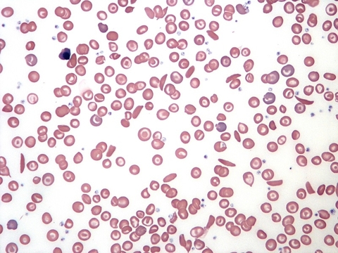 Sickle cell smear Sickle cell smear