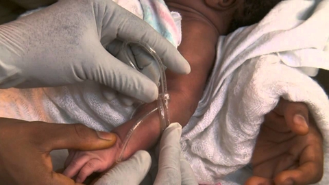 Infant receiving intravenous feeding Infant receiving intravenous feeding