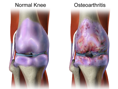 osteoarthritis osteoarthritis