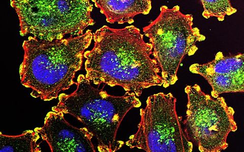 metastatic melanoma cells - National Cancer Institute melanoma