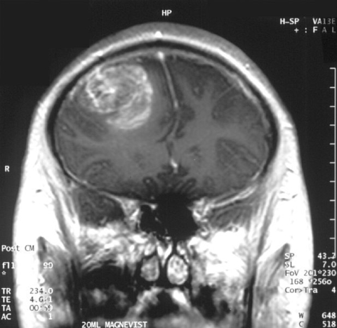 Glioblastoma 1 Glioblastoma 1