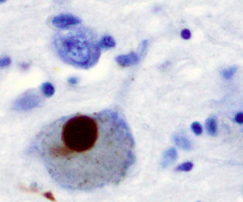 A Lewy body in a brain cell of the substantia nigra in Parkinson's disease Parkinson's brain cell