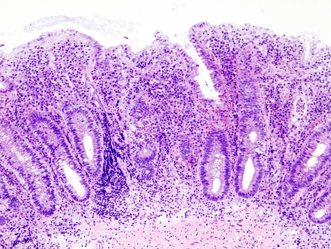 Histopathological image of the active stage of ulcerative colitis. Ulcerative colitis.