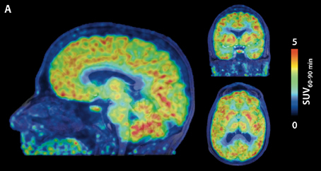 Martinostat imaging of the human brain Martinostat imaging of the human brain